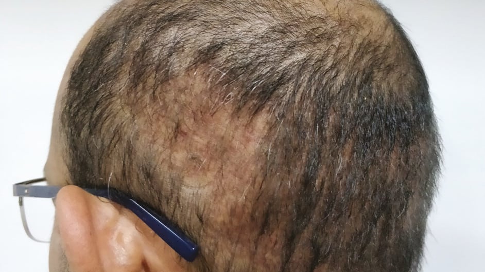 Αποτυχημένη μεταμόσχευση μαλλιών
