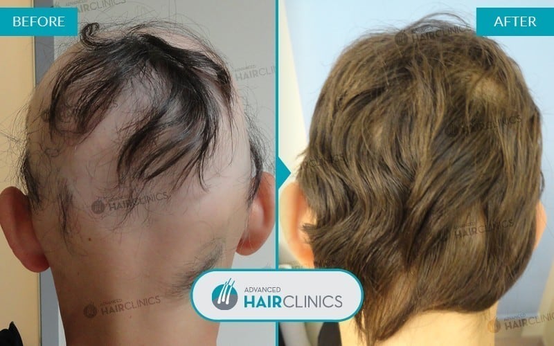 Autologous hair mesotherapy after 6 sessions, before and after the treatment, back. Result 001.