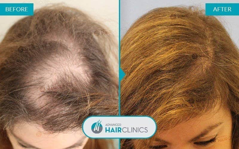 Autologous Hair Mesotherapy after 9 sessions. Before and after treatment, top. Result 002.