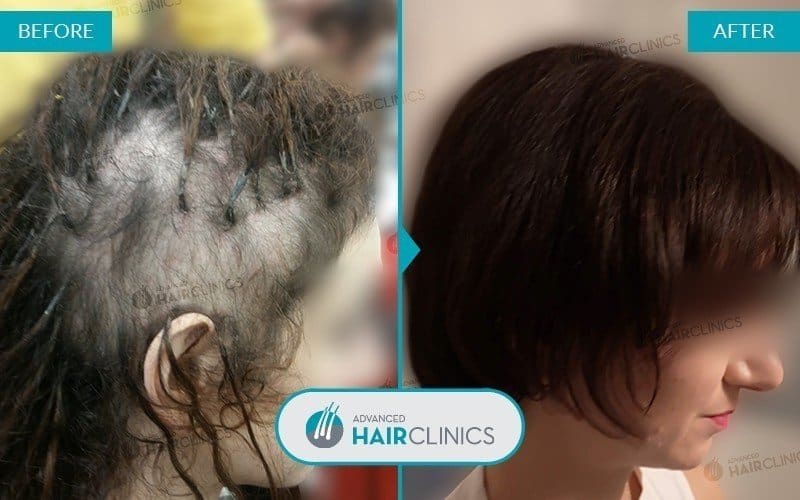 Autologous Hair Mesotherapy after 12 sessions. Before and after treatment, front. Result 003.