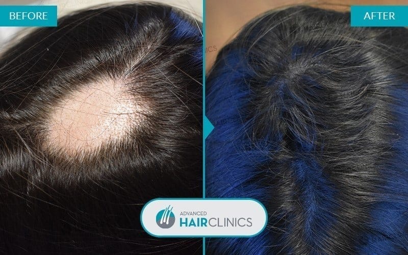 Autologous hair mesotherapy after 9 sessions, before and after treatment, top. Result 004.