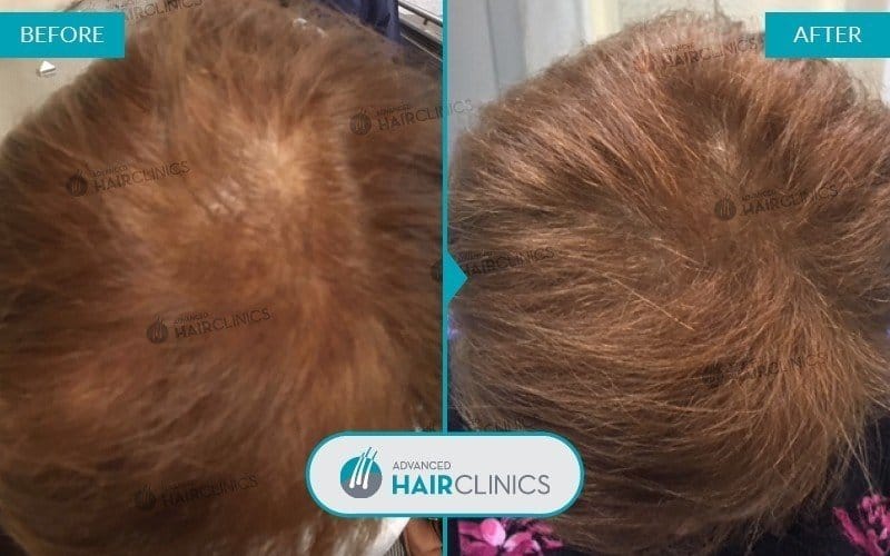 Autologous Hair Mesotherapy after 3 sessions. Before and after treatment, front. Result 005.
