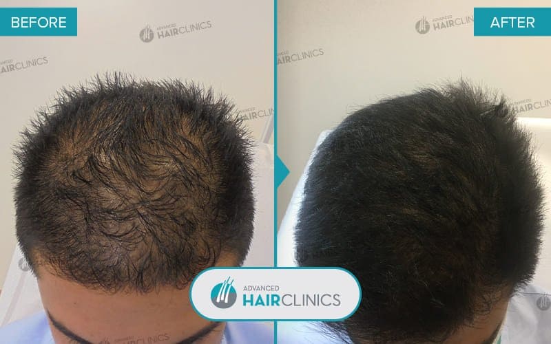 Autologous Hair Mesotherapy after 10 sessions. Before and after treatment, front. Result 006.