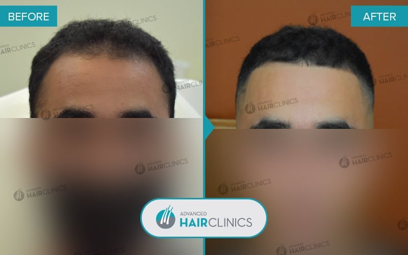 Autologous Hair Mesotherapy after 5 sessions. Before and after treatment, front. Result 007.