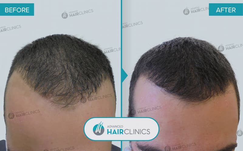 Autologous Hair Mesotherapy after 11 sessions. Before and after treatment, front. Result 008.