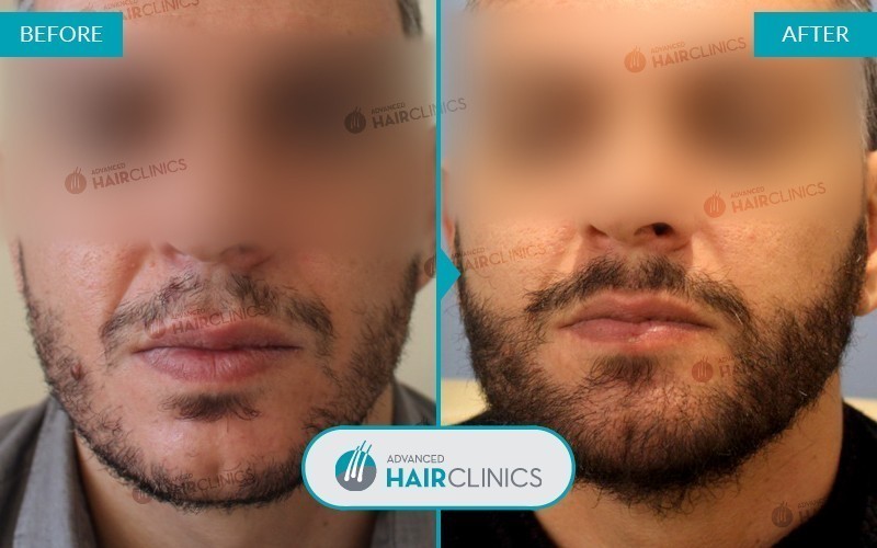 Greffe de barbe FUE avec 1.716 follicules. Avant et apr&egrave;s le traitement, de face. R&eacute;sultat 001.