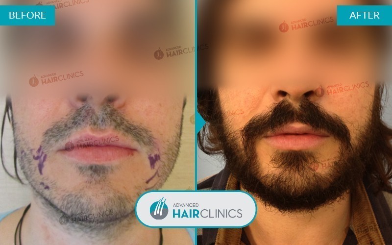 Greffe de barbe FUE avec 293 follicules. Avant et apr&egrave;s le traitement, de face. R&eacute;sultat 002.