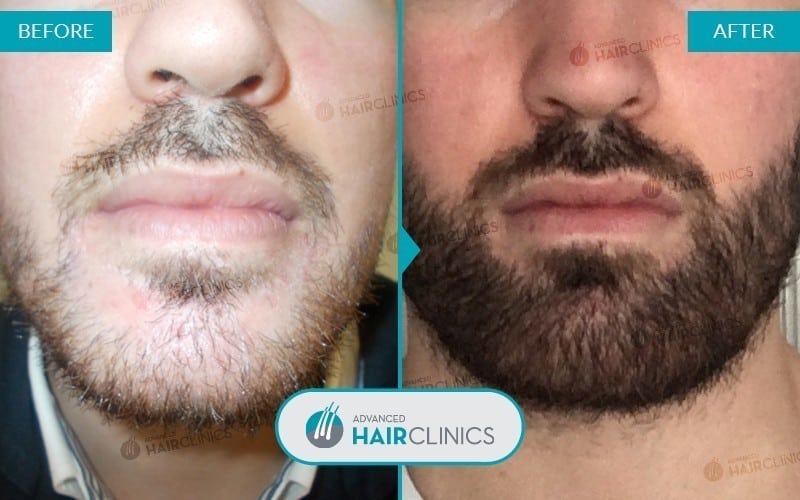 Greffe de barbe FUE avec 1.824 follicules. Avant et apr&egrave;s le traitement, de face. R&eacute;sultat 003.