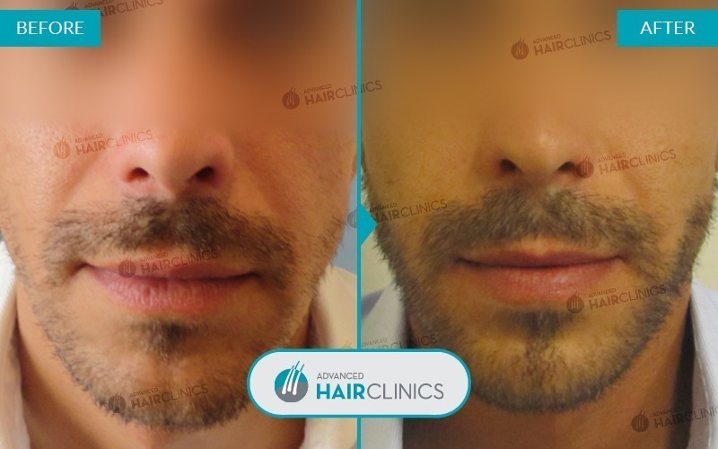 Greffe de barbe FUE avec 1.146 follicules. Avant et apr&egrave;s le traitement, de face. R&eacute;sultat 005.