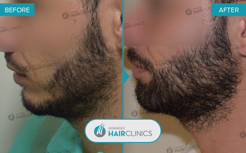 Greffe de barbe FUE avec 1.961 follicules. Avant et apr&egrave;s le traitement, de face. R&eacute;sultat 007.