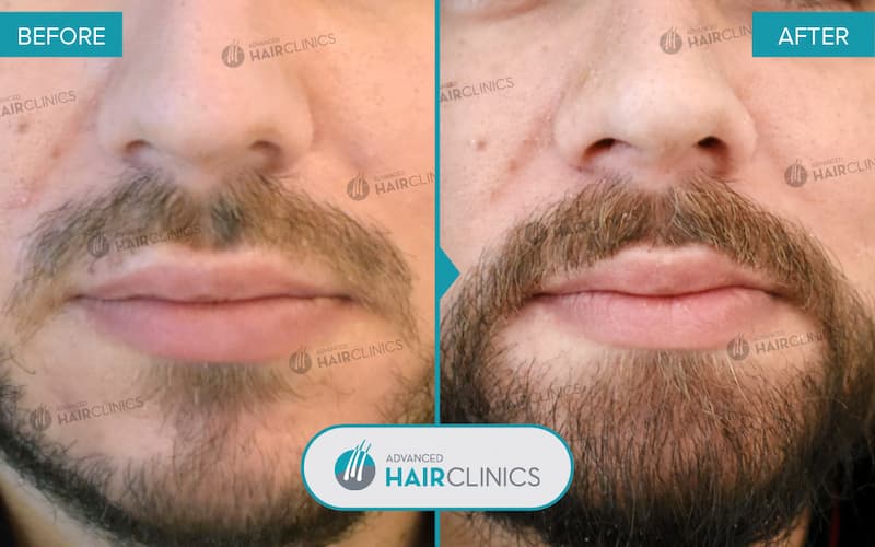 Greffe de barbe FUE avec 498 follicules. Avant et apr&egrave;s le traitement, de face. R&eacute;sultat 008.