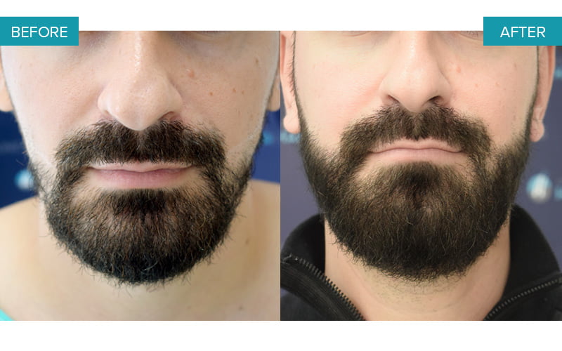 Greffe de barbe FUE avec 1.700 follicules. Avant et apr&egrave;s le traitement, de face. R&eacute;sultat 009.