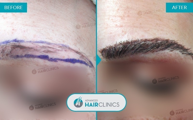 FUE eyebrow transplant with 627 hair grafts. Before and after treatment, front. Result 001.