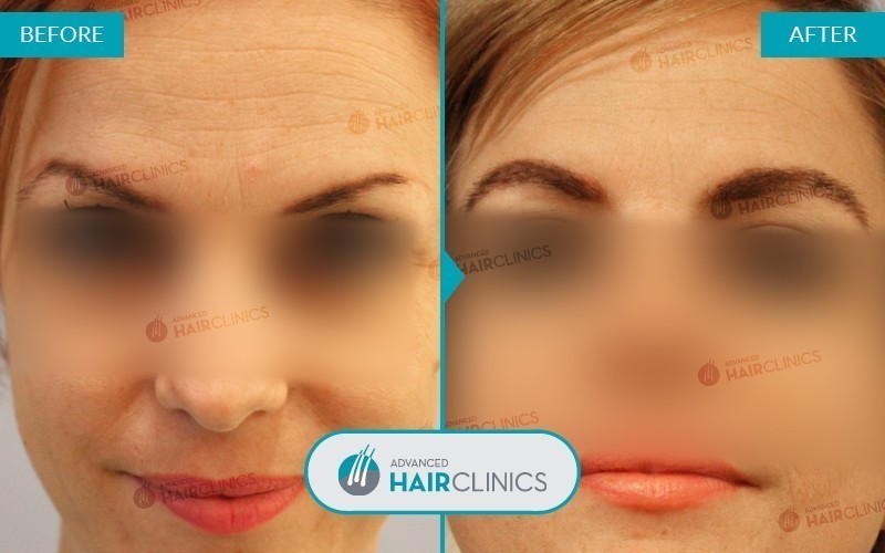 FUE eyebrow transplant with 535 hair grafts. Before and after treatment, front. Result 002.