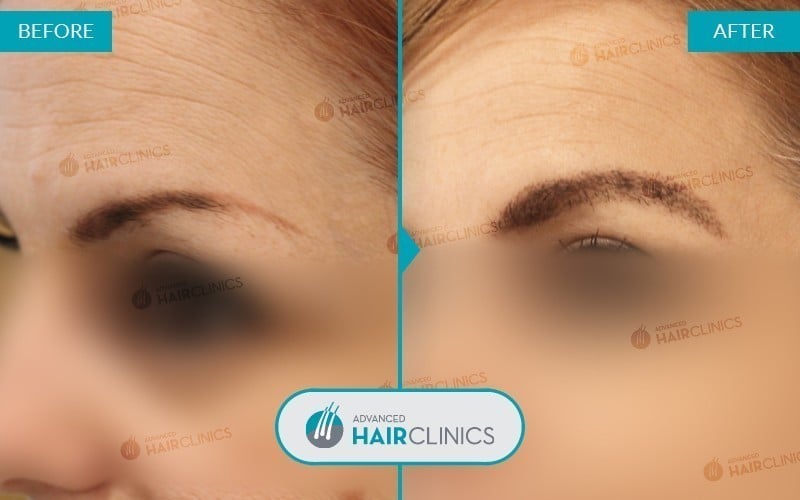 FUE eyebrow transplant with 535 hair grafts. Before and after treatment, front. Result 002.