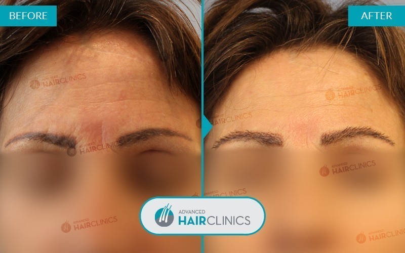FUE eyebrow transplant with 352 hair grafts. Before and after treatment, front. Result 003.