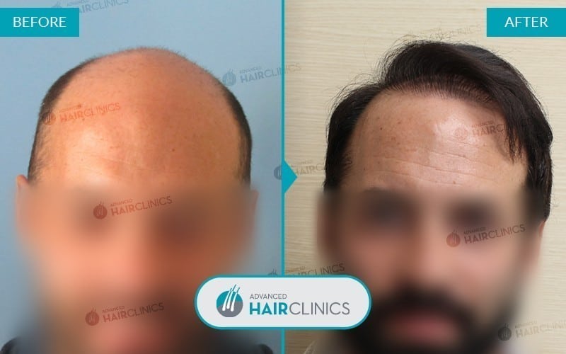 FUE haartransplantatie met 8.947 grafts. Voor en na de behandeling. Resultaat 005.