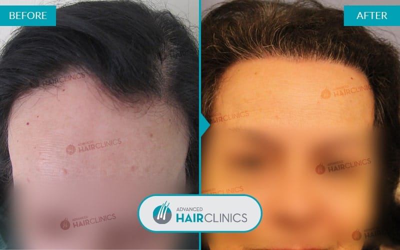 FUE haartransplantatie met 1.099 grafts. Voor en na de behandeling. Resultaat 017.