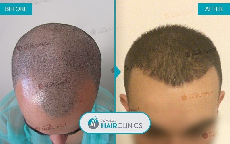 FUE haartransplantatie met 1.323 grafts. Voor en na de behandeling. Resultaat 018.