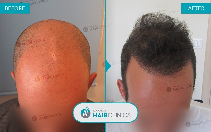 FUE haartransplantatie met 4.679 grafts. Voor en na de behandeling. Resultaat 022.