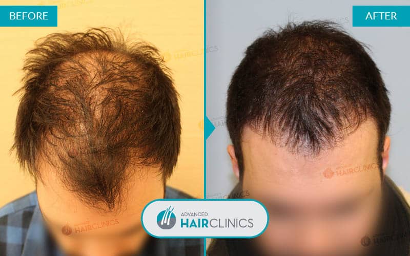 FUE haartransplantatie met 2.363 grafts. Voor en na de behandeling. Resultaat 025.