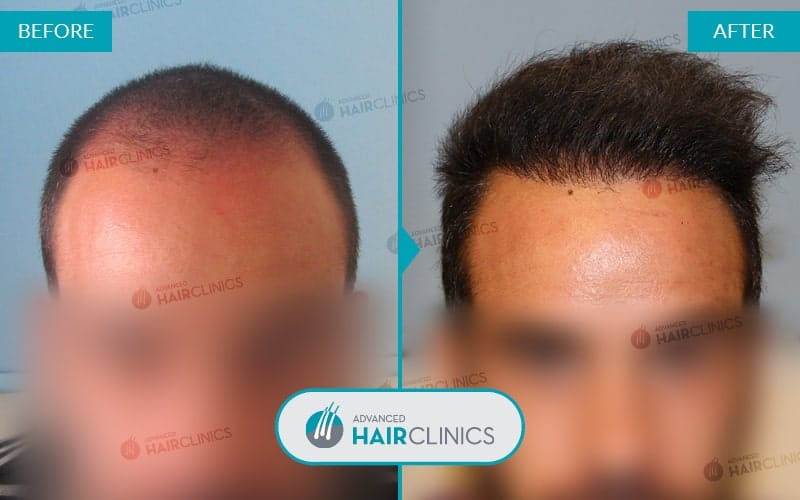 FUE haartransplantatie met 3.353 grafts. Voor en na de behandeling. Resultaat 026.
