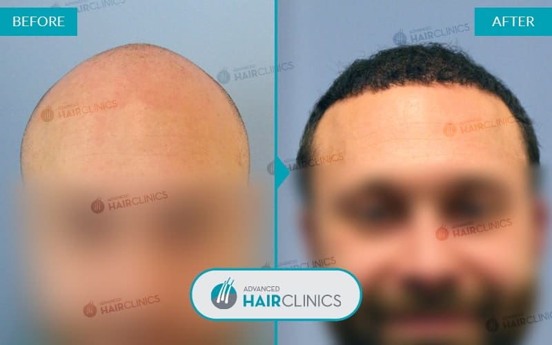 FUE haartransplantatie met 3.820 grafts. Voor en na de behandeling. Resultaat 027.