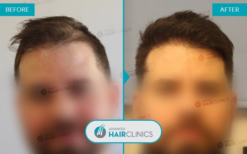 FUE haartransplantatie met 4.639 grafts. Voor en na de behandeling. Resultaat 030.