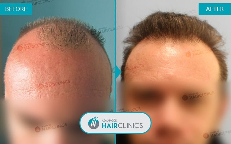 FUE haartransplantatie met 3.005 grafts. Voor en na de behandeling. Resultaat 034.