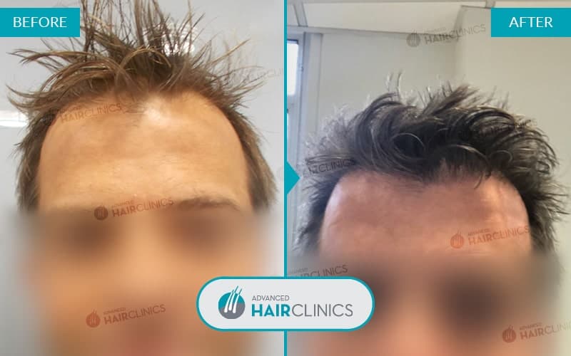 FUE haartransplantatie met 1.885 grafts. Voor en na de behandeling. Resultaat 036.