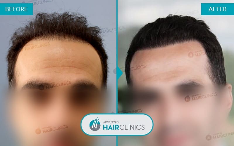 FUE haartransplantatie met 3.150 grafts. Voor en na de behandeling. Resultaat 037.