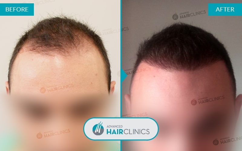 FUE haartransplantatie met 2.695 grafts. Voor en na de behandeling. Resultaat 038.