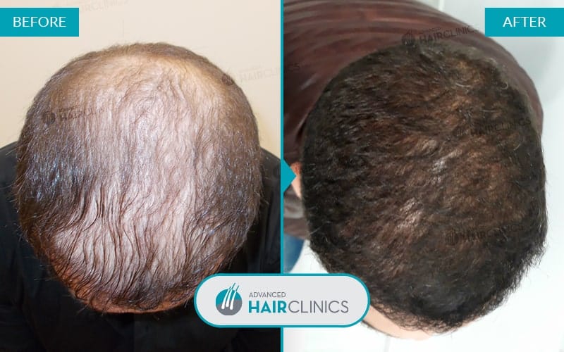 FUE haartransplantatie met 4.925 grafts. Voor en na de behandeling. Resultaat 039.