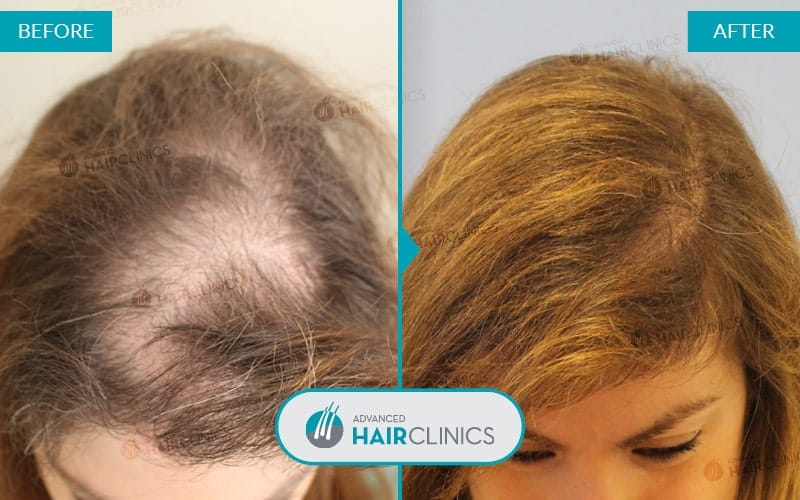 FUE haartransplantatie met 1.020 grafts. Voor en na de behandeling. Resultaat 040.