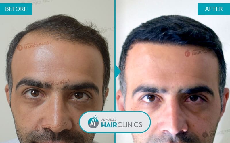 FUE haartransplantatie met 2.242 grafts. Voor en na de behandeling. Resultaat 041.