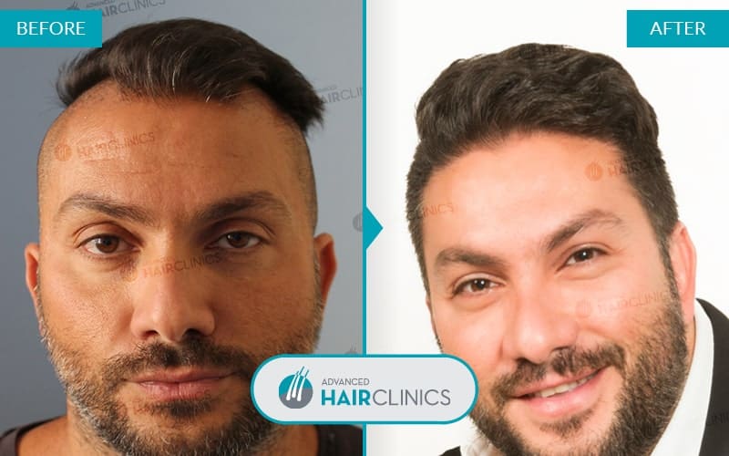 FUE haartransplantatie met 1.850 grafts. Voor en na de behandeling. Resultaat 042.