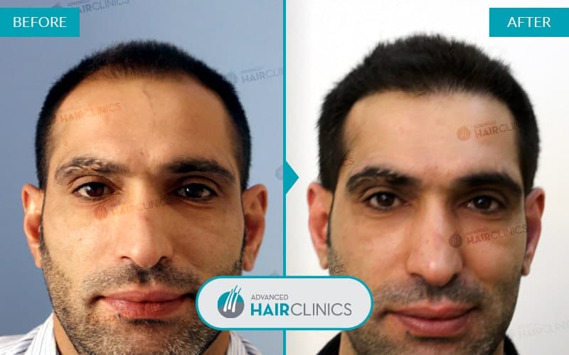 FUE haartransplantatie met 5.187 grafts. Voor en na de behandeling. Resultaat 045.