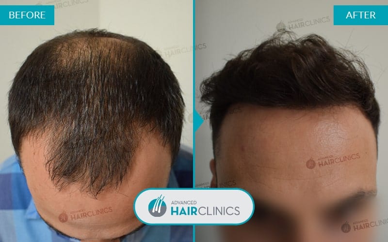 FUE haartransplantatie met 4.247 grafts. Voor en na de behandeling. Resultaat 047.