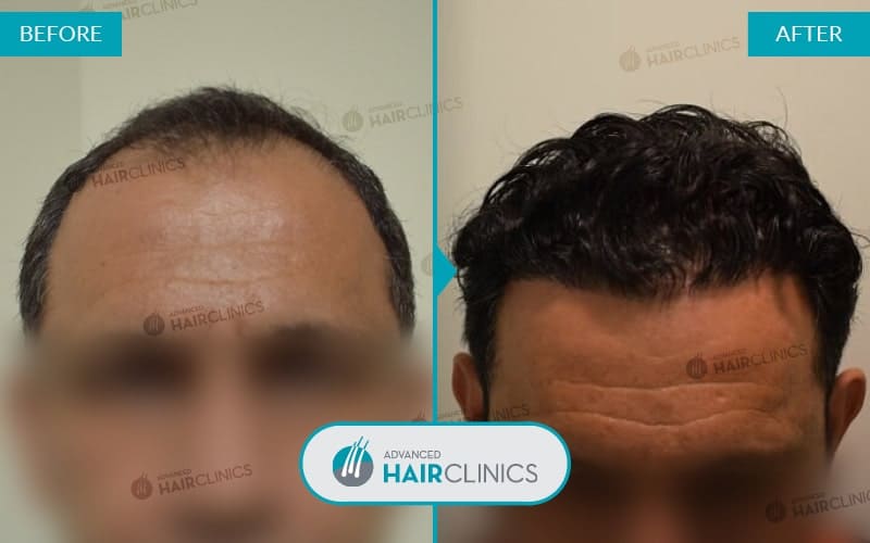 FUE haartransplantatie met 2.155 grafts. Voor en na de behandeling. Resultaat 048.