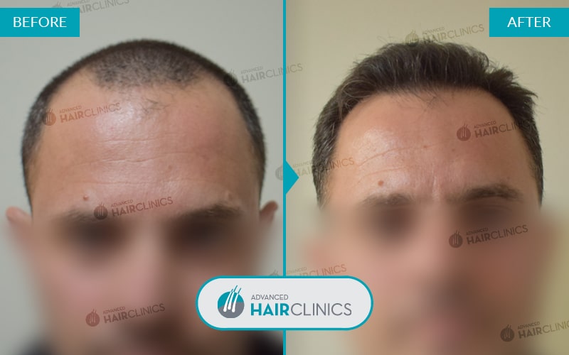 FUE haartransplantatie met 2.403 grafts. Voor en na de behandeling. Resultaat 049.