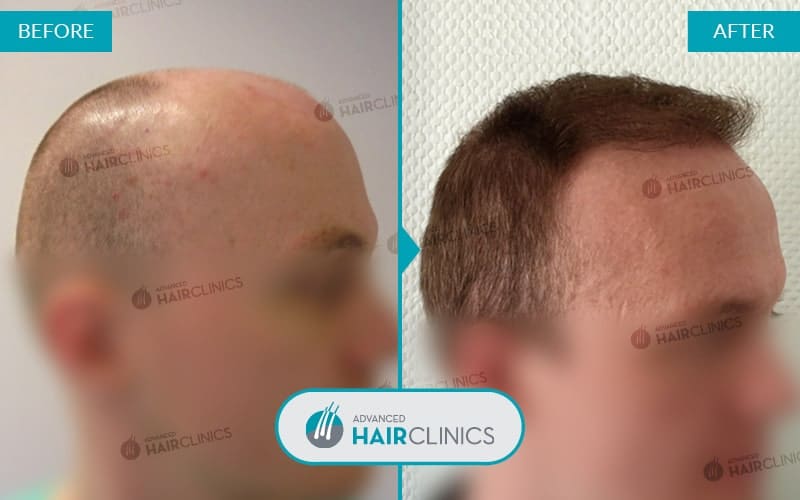 FUE haartransplantatie met 4.951 grafts. Voor en na de behandeling. Resultaat 050.