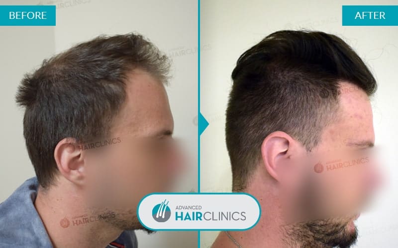 FUE haartransplantatie met 2.625 grafts. Voor en na de behandeling. Resultaat 051.