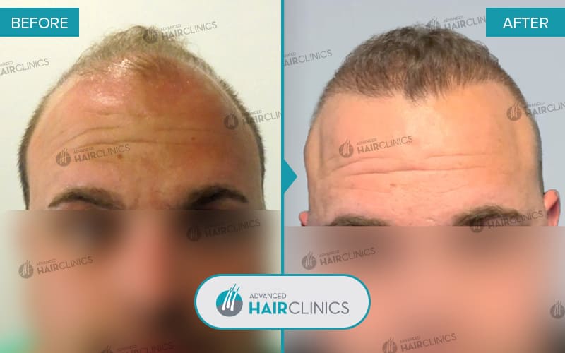 FUE haartransplantatie met 2.031 grafts. Voor en na de behandeling. Resultaat 052.