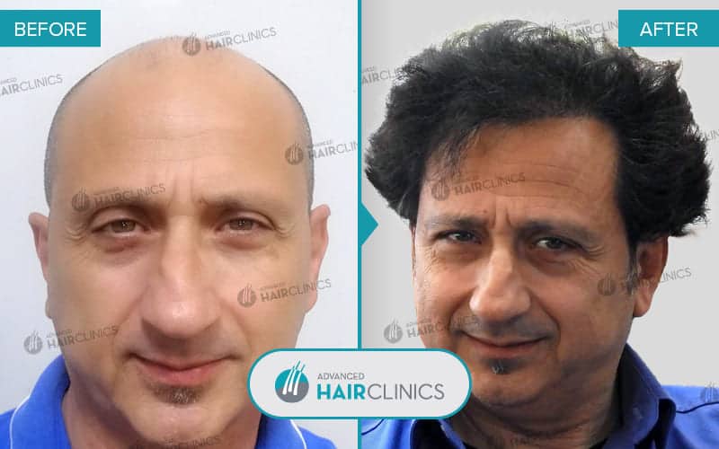FUE hair transplant with 6.895 hair grafts. Before and after treatment. Result 054.