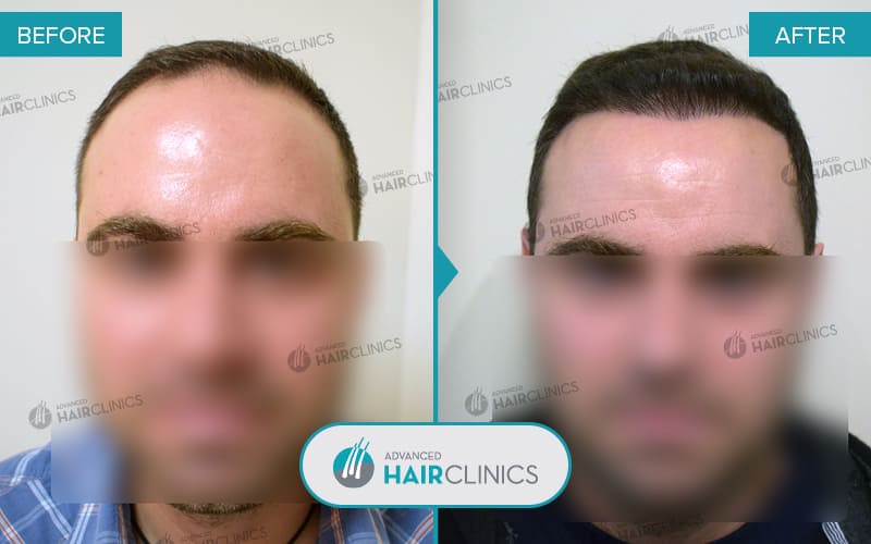 FUE hair transplant with 2.192 hair grafts. Before and after treatment. Result 059.