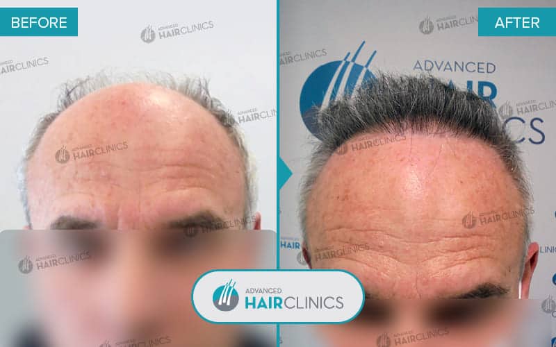 FUE hair transplant with 3.992 hair grafts. Before and after treatment. Result 062.