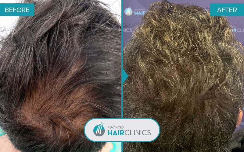 FUE hair transplant with 1.300 hair grafts. Before and after treatment. Result 064.
