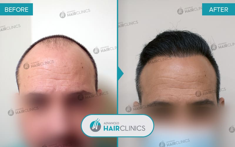 FUE hair transplant with 2.109 hair grafts. Before and after treatment. Result 065.