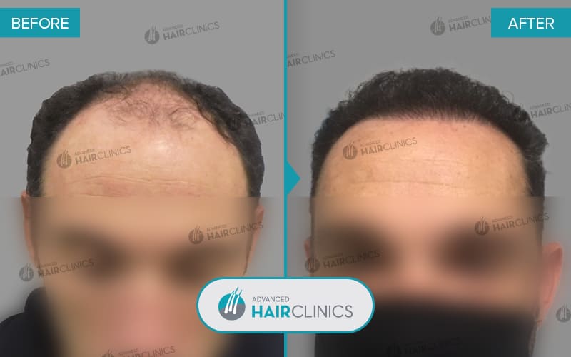 FUE hair transplant with 2.387 hair grafts. Before and after treatment. Result 066.