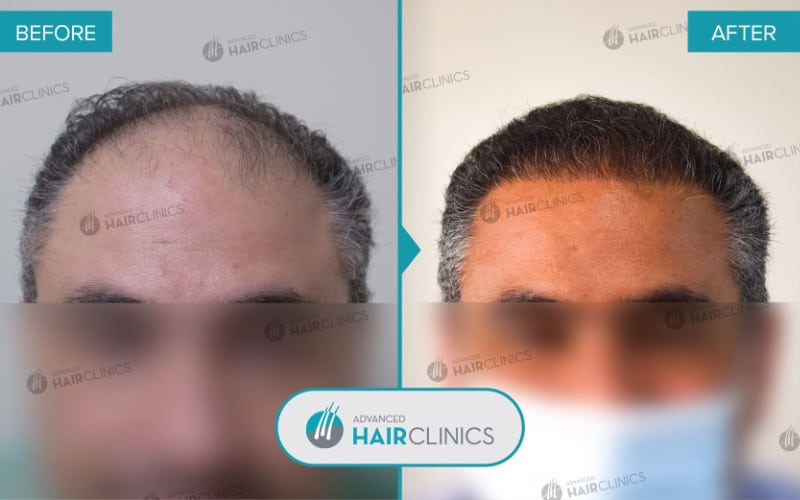 FUE hair transplant with 3.530 hair grafts. Before and after treatment. Result 068.
